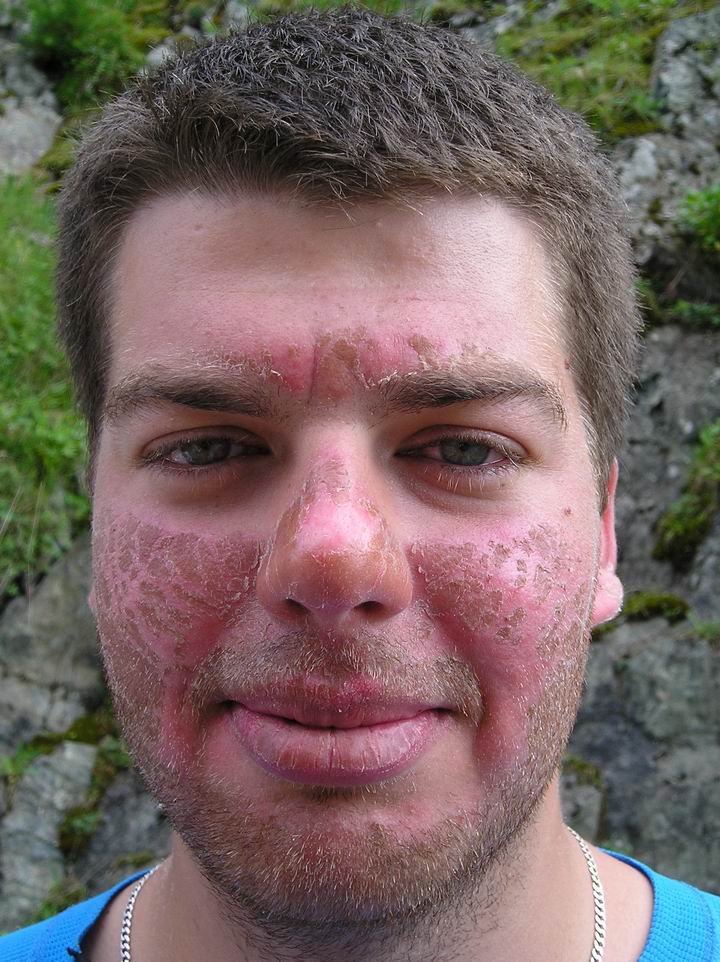 POZOR!! Toto není fotomontáž...Ondra který usnul na kameni pod Gran Paradisem dopadl takhle...